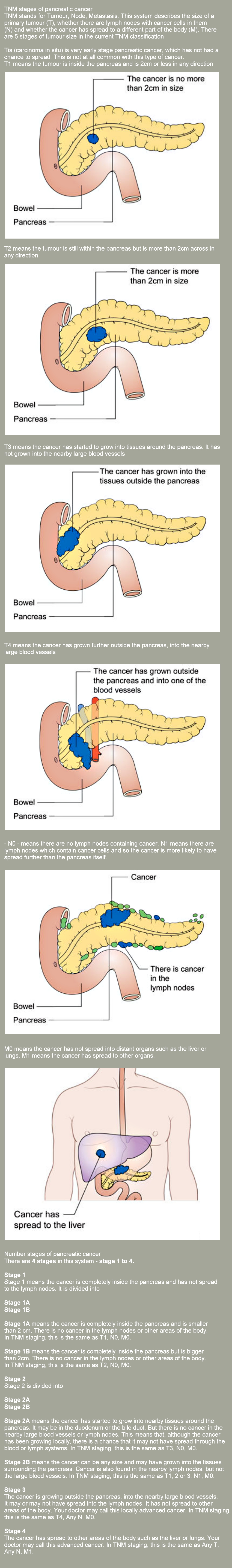 stages-of-pancreatic-cancer