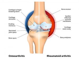 rheumatoid arthritis.